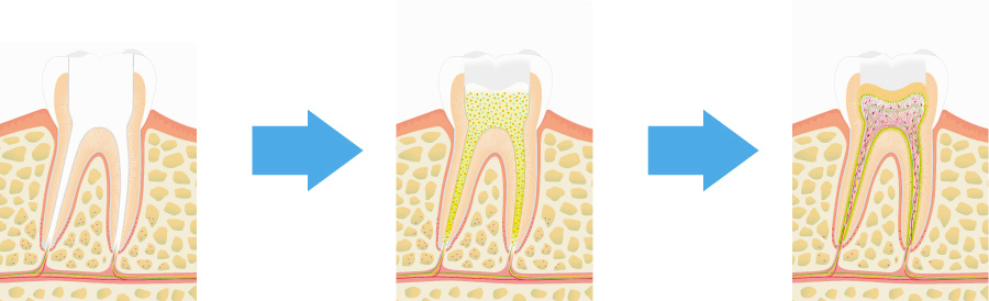 歯髄幹細胞図解